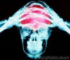migraine pain.webp
