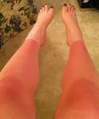 Sunburns Suck.webp