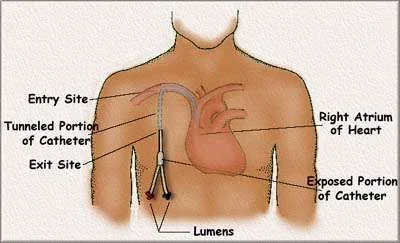 Pheresis Catheter.webp