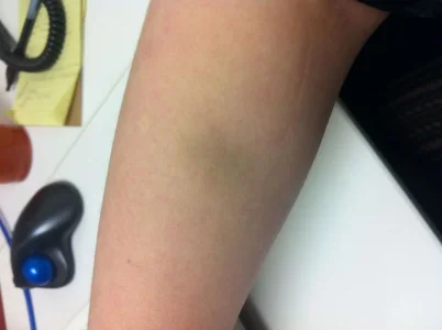 Bruise.webp