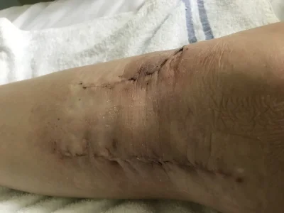 fractured knee, metal plates and screw. right leg.webp