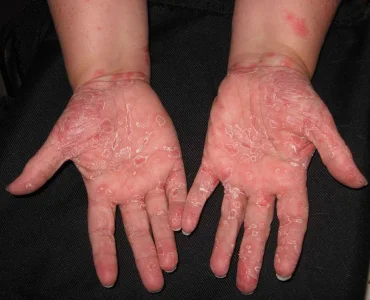 Hands - palms.webp